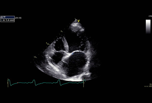 Figure 2: Tenting Area (TA)- Area enclosed between mitral leaflets and
annular plane.